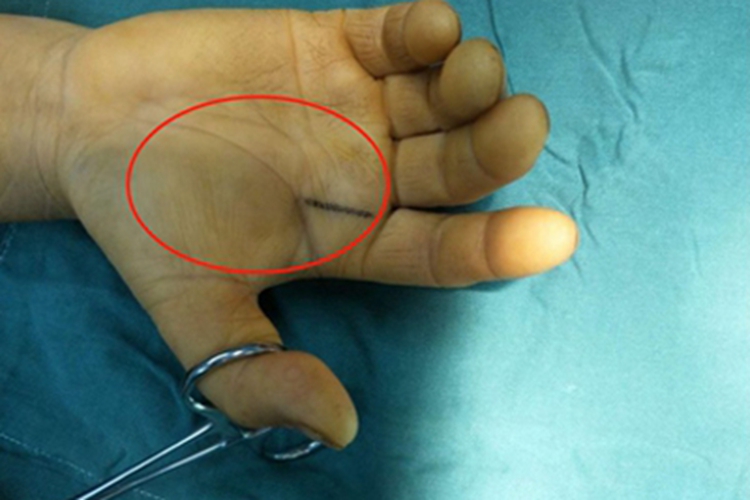 脂肪瘤手掌里长个结节图
