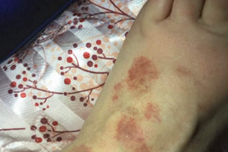 进行性色素性紫癜性皮病红斑图 进行性色素性紫癜性皮病红斑图