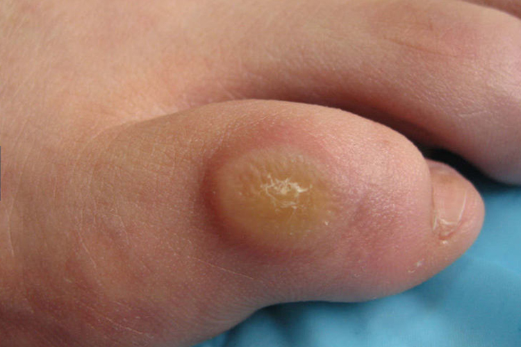 小趾外侧鸡眼图