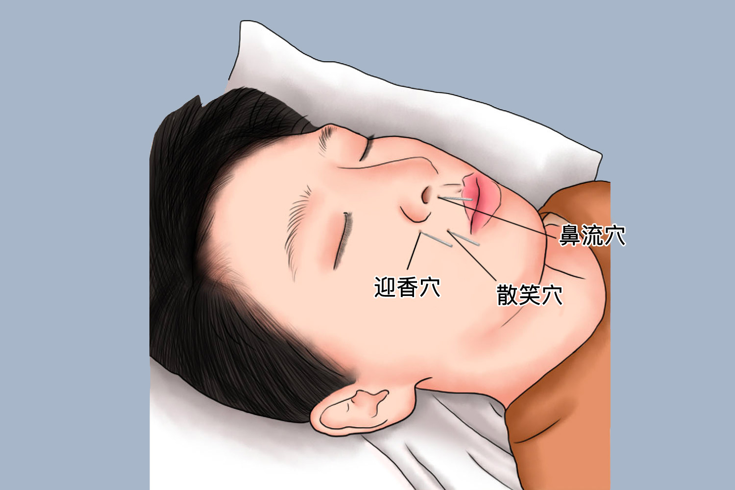 鼻炎针灸部位图