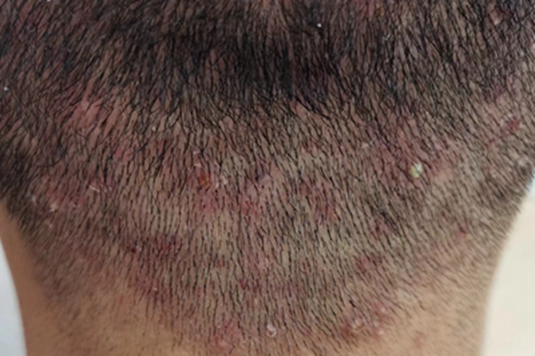 细菌性毛囊炎后颈脓疱图 细菌性毛囊炎后颈脓疱图