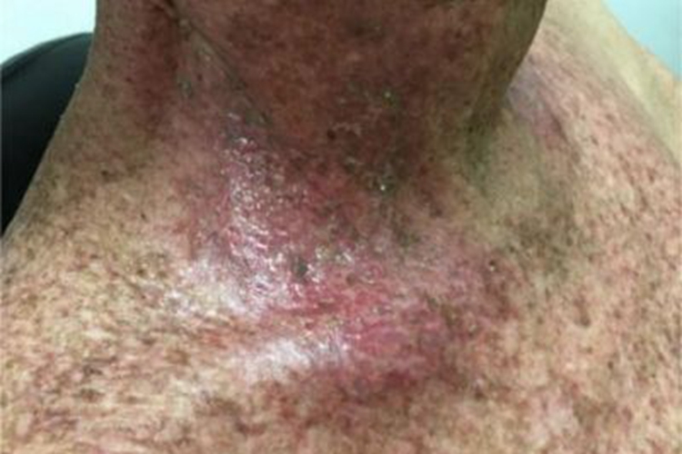 Ⅱ度急性放射性皮炎颈部糜烂图