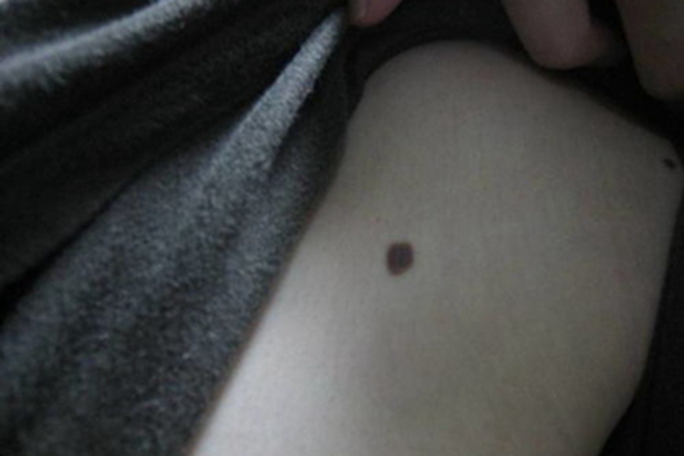 复合痣胳膊症状图 复合痣胳膊症状图