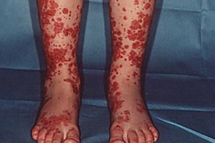 皮肤小血管炎初期图 皮肤小血管炎初期图