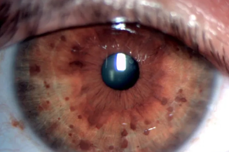 Lisch结节图 Lisch结节图