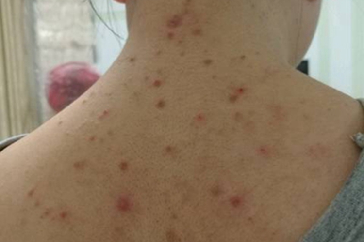 淋巴瘤样丘疹病丘疹图 淋巴瘤样丘疹病丘疹图