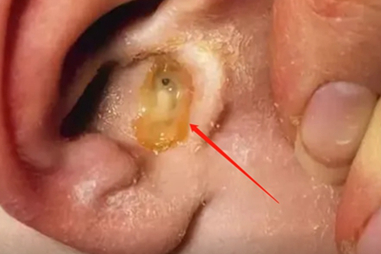 脓血型猩红热耳部症状图