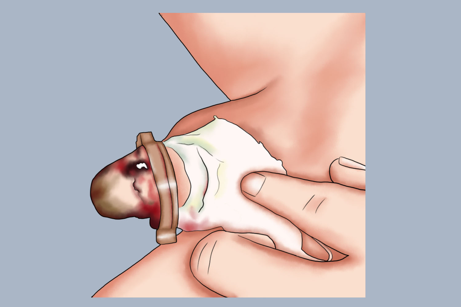 包茎手术术后炎症感染图