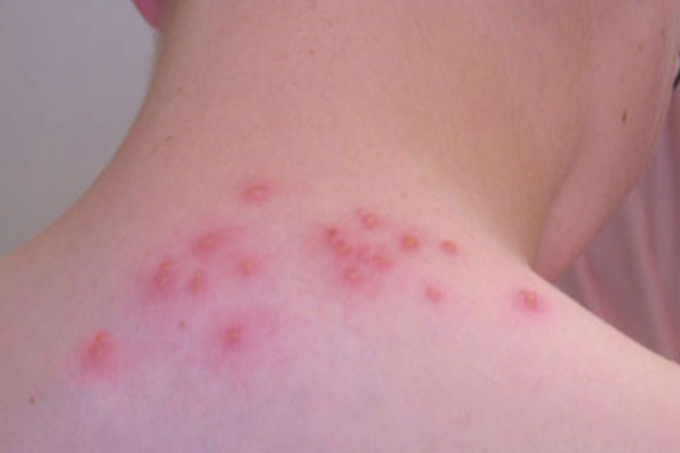 丘疹性荨麻疹图