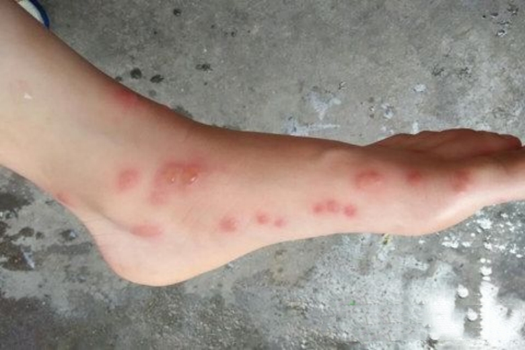 糖尿病脚上有水疱图