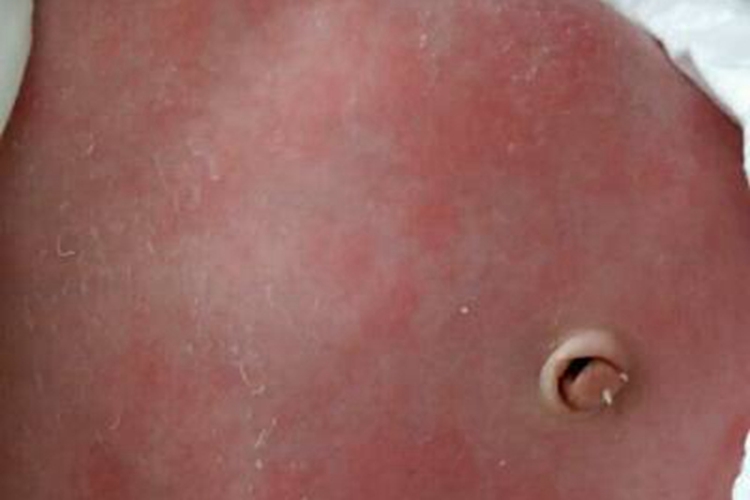 新生儿毒性红斑症状图