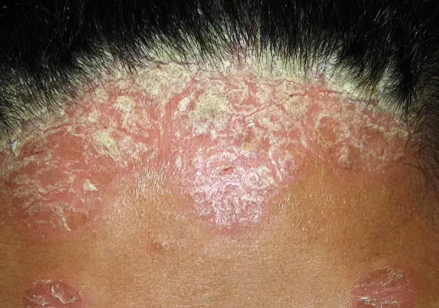 银屑病头皮屑图