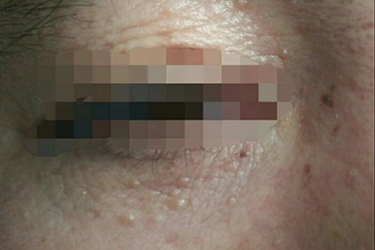汗管瘤眼周有多个小疙瘩图 汗管瘤眼周有多个小疙瘩图
