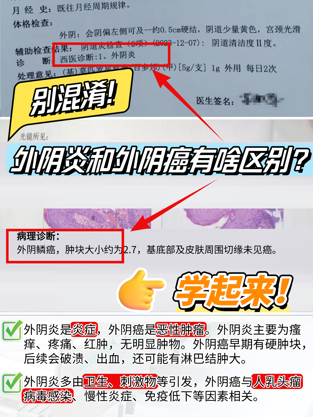 别混淆！外阴炎和外阴癌有啥区别？学起来