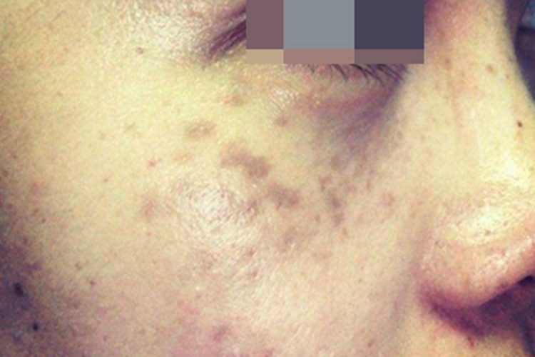 颧部褐青色痣症状图