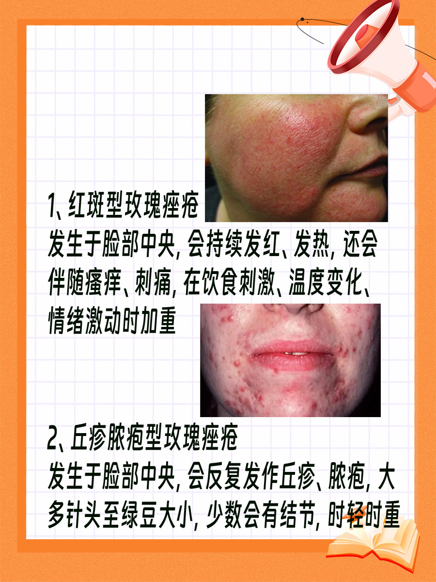 玫瑰痤疮的4种类型，快来看看你是属于哪一种