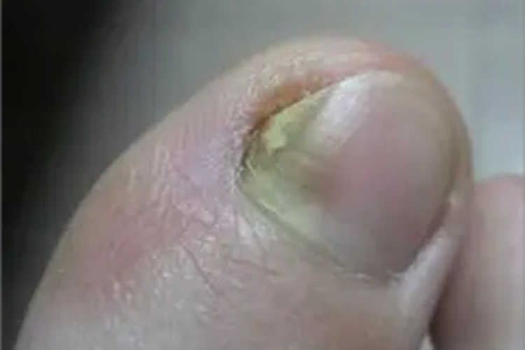 慢性甲沟炎脚趾甲变黄缺损图