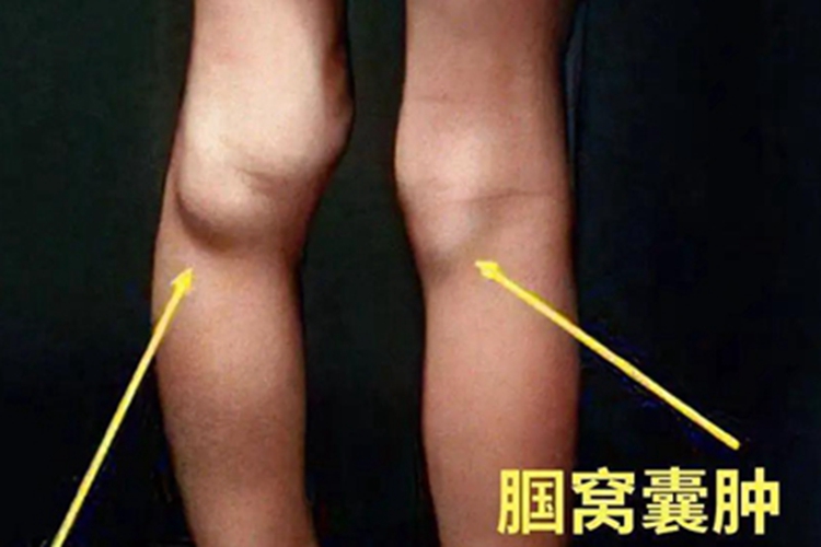 儿童腘窝囊肿腘窝包块图