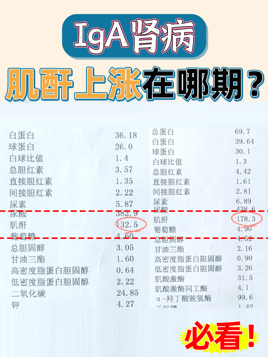 IgA肾病:肌酐上涨在哪期?必看!
