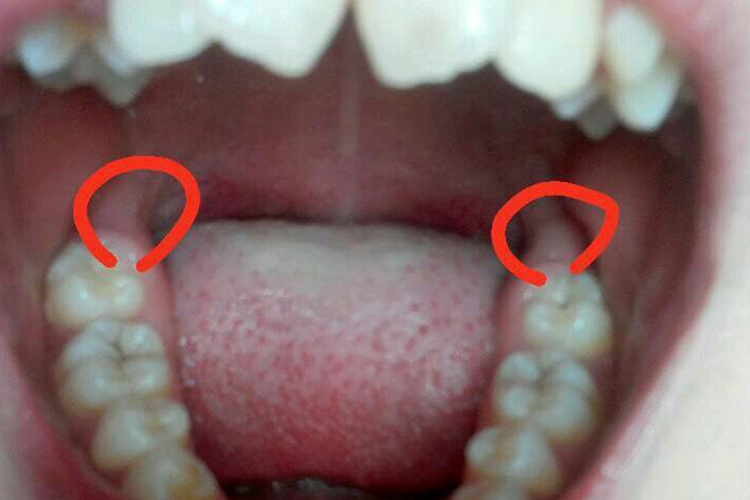 磨牙后垫位置图