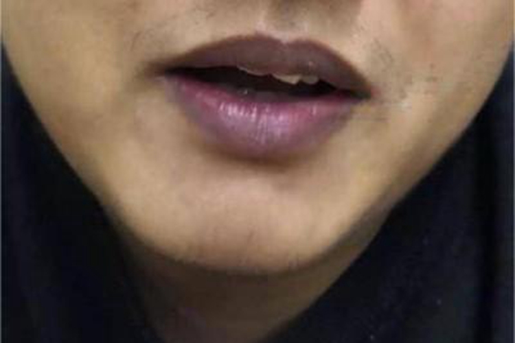 急性一氧化碳中毒嘴唇皮肤发紫图