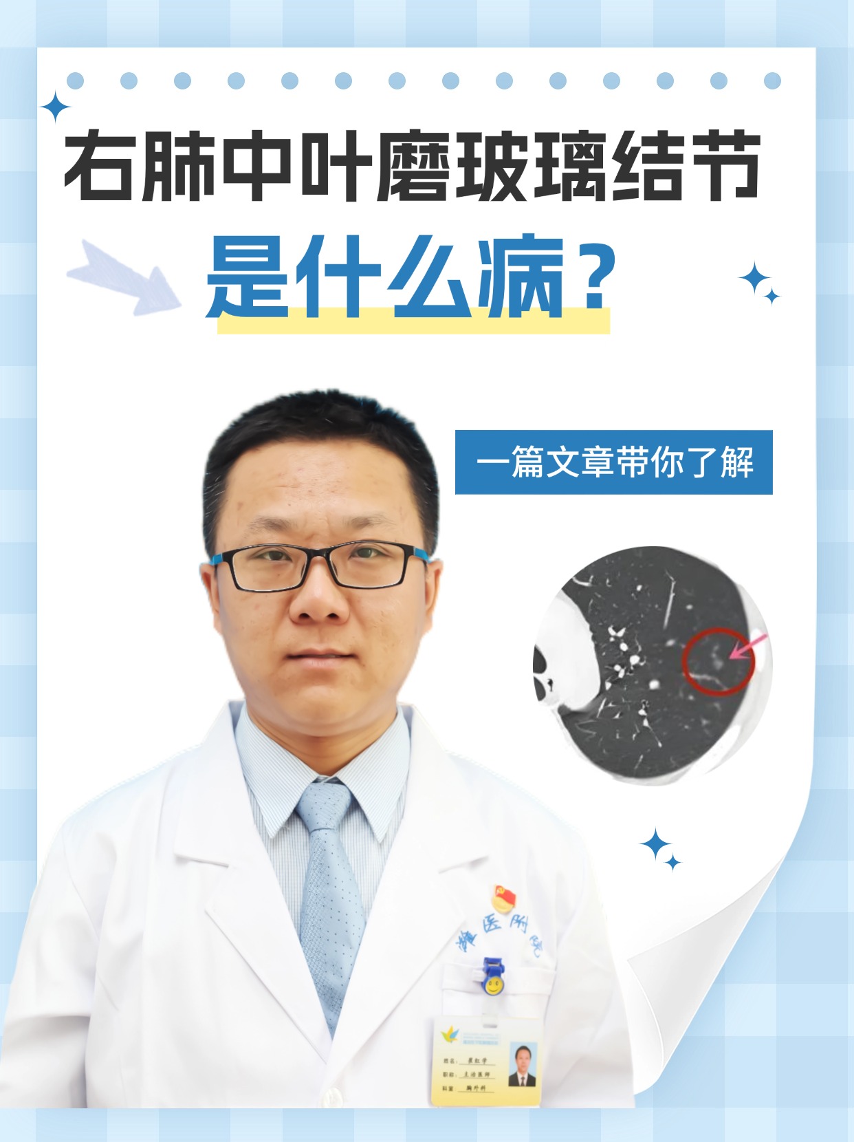 右肺中叶磨玻璃结节是什么病？一篇文章带你了解