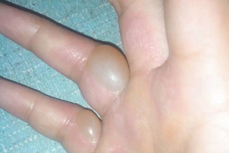 手浅表性大疱性脓皮病手指水疱图 手浅表性大疱性脓皮病手指水疱图