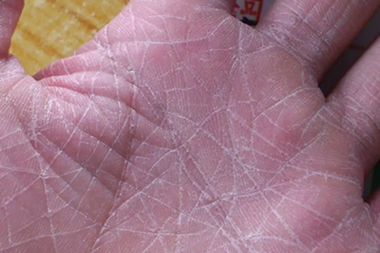 条纹状掌跖角化病症状图