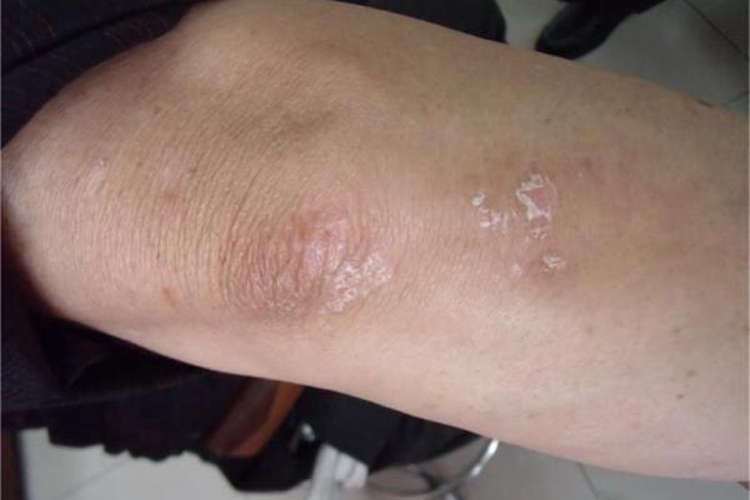 毛发红糠疹性红皮病肘部脱皮图 毛发红糠疹性红皮病肘部脱皮图