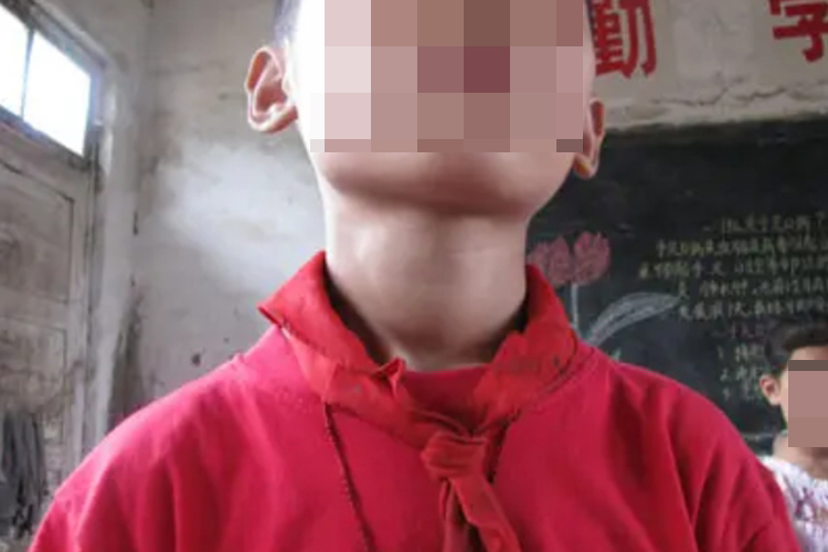 小儿慢性淋巴细胞性甲状腺炎甲状腺肿大图