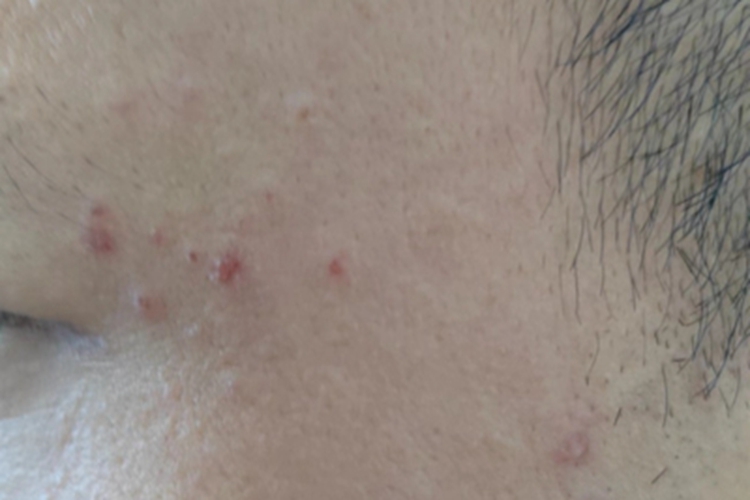 扁平疣眼角症状图