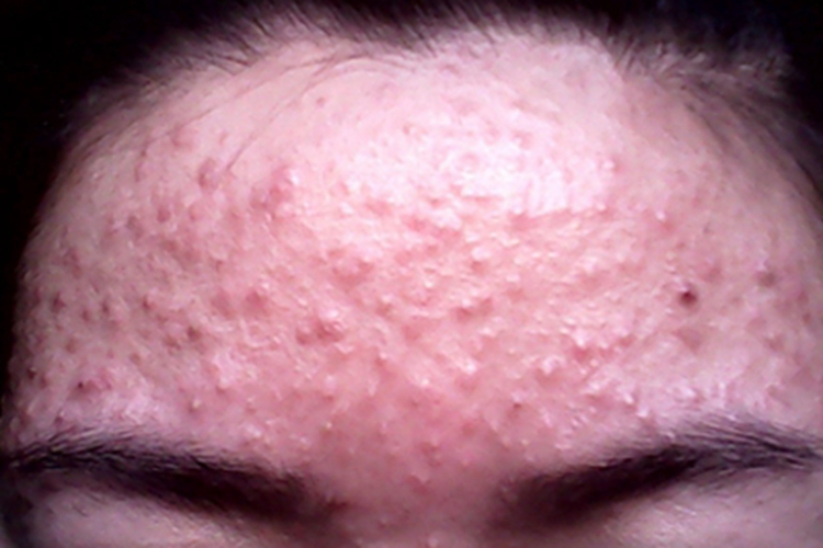 细菌性毛囊炎前额丘疹图