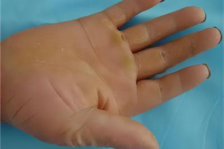 可变性红斑角化病手掌脱屑图 可变性红斑角化病手掌脱屑图
