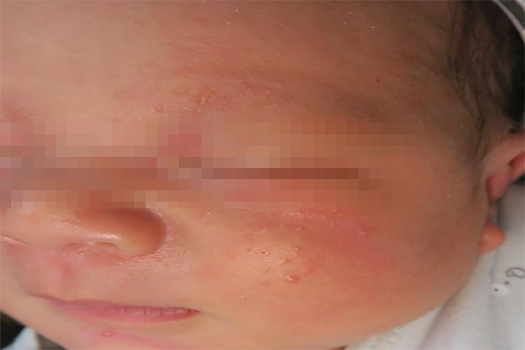 湿疹样丘疹图