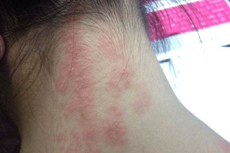 皮肤过敏红肿后颈小红疙瘩图 皮肤过敏红肿后颈小红疙瘩图