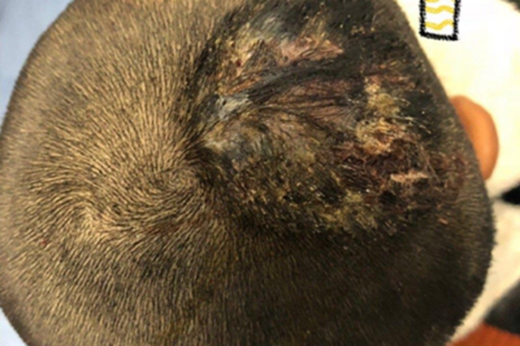 头癣头部症状图