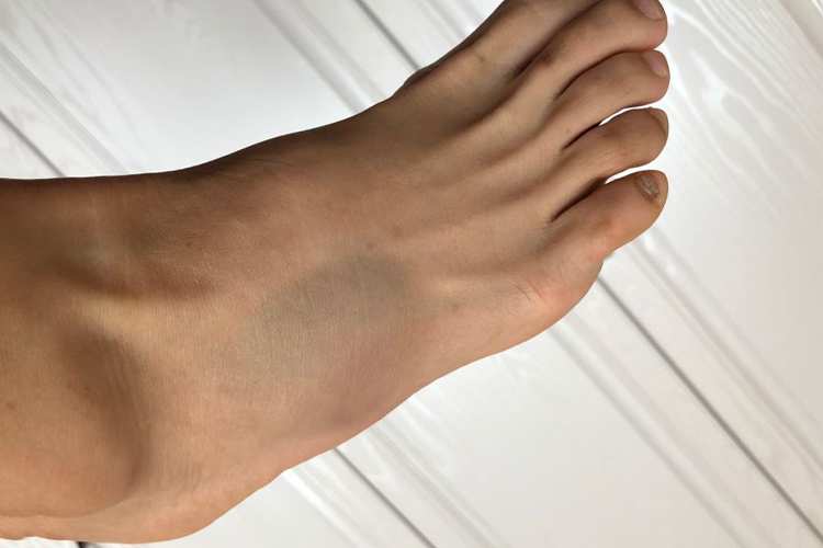 右足第5跖骨基底部骨折图