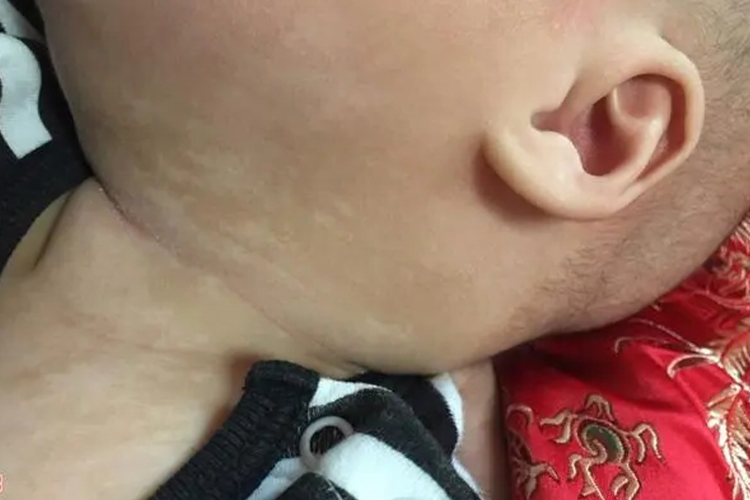 婴幼儿花斑糠疹图