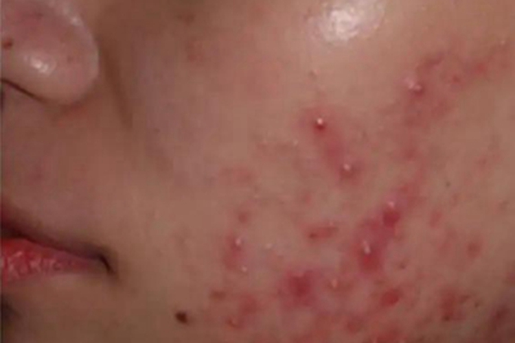 痤疮面部红疙瘩有白尖图