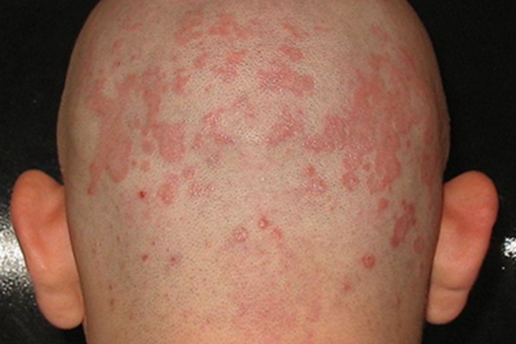 自体敏感性湿疹丘疹图