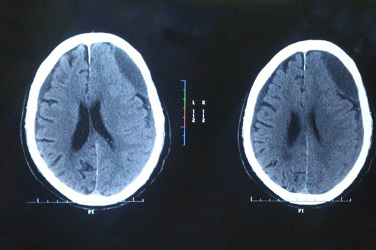 左侧慢性硬膜下血肿CT图 左侧慢性硬膜下血肿CT图