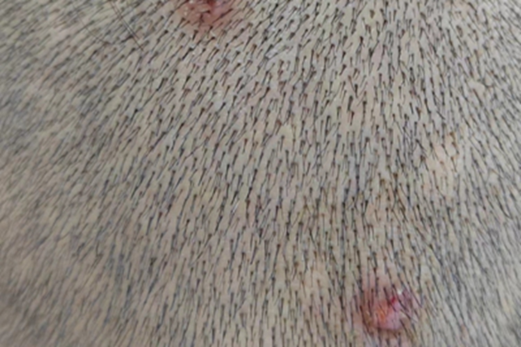 结节性痒疹头皮血痂图