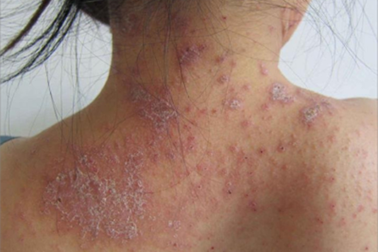 痒疹型多形性日光疹背部红斑图 痒疹型多形性日光疹背部红斑图