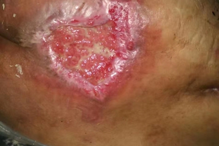 溃疡期压疮臀部症状图 溃疡期压疮臀部症状图