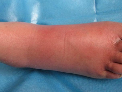 急性一氧化碳中毒脚红肿图.jpg