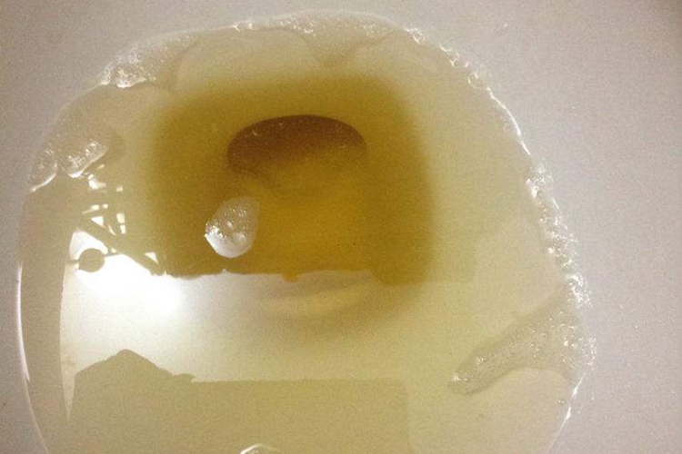 肾型过敏性紫癜蛋白尿图