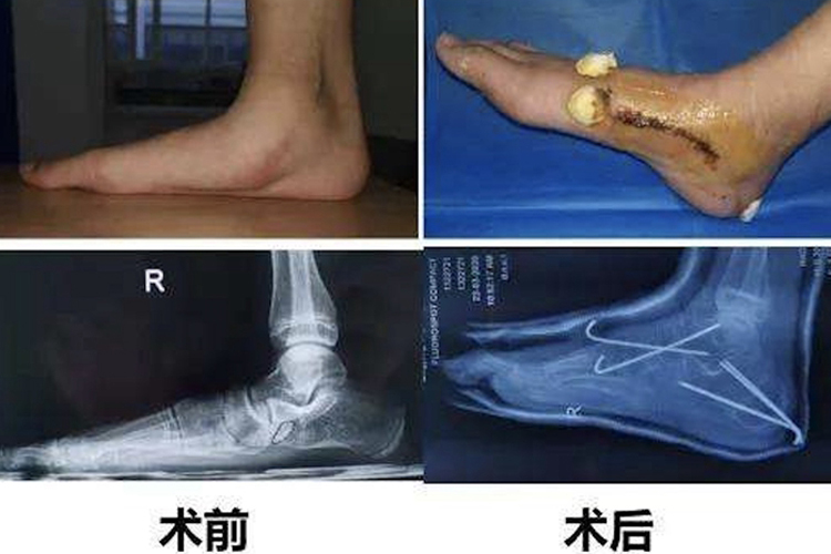 扁平足手术矫形图