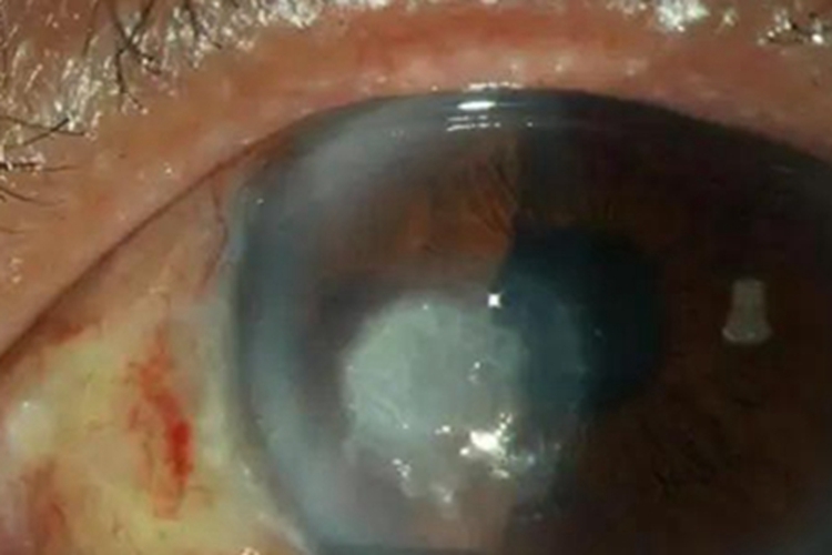 细菌性角膜炎眼球白斑图