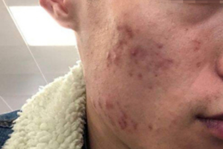 寻常痤疮右侧面部丘疹图