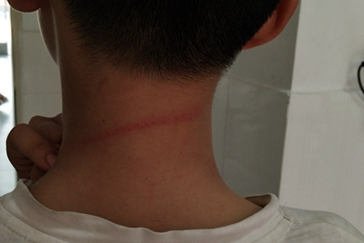 刮伤后颈症状图